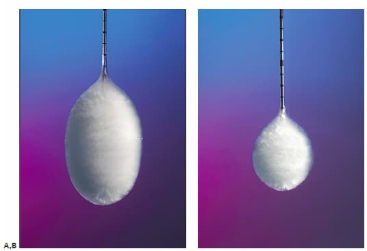 التجميد| الكي البارد للأعصاب